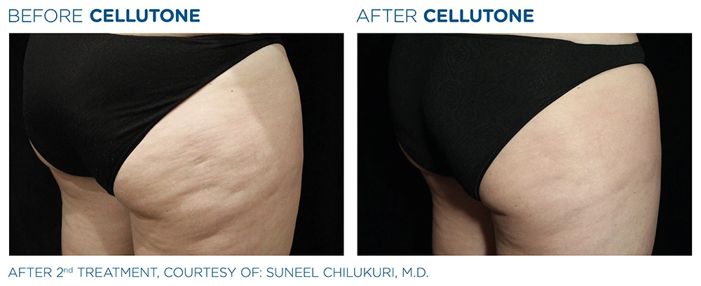 Cellutone Before & After | Image Gallery | Neo Body Med Spa
