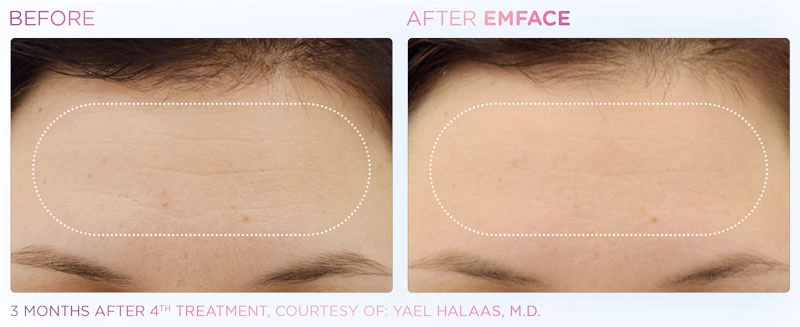 EMSFACE Before & After | Image Gallery | Neo Body Med Spa