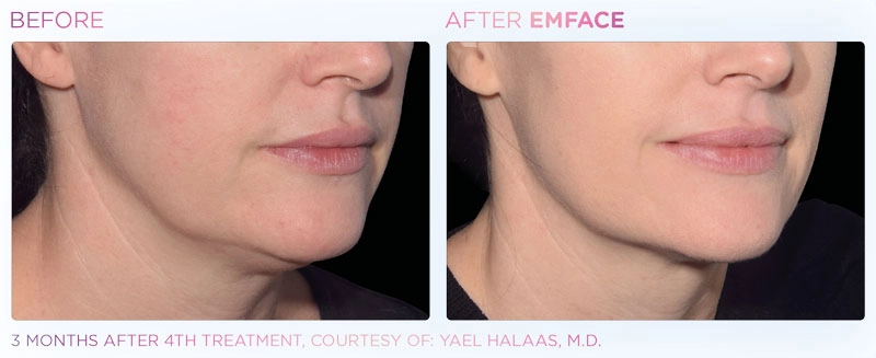 EMSFACE Before & After | Image Gallery | Neo Body Med Spa