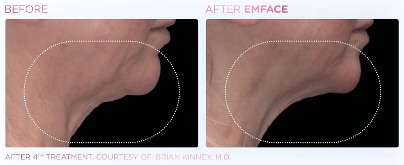 EMSFACE Before & After | Image Gallery | Neo Body Med Spa