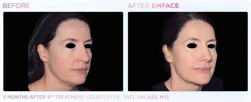 EMSFACE Before & After | Image Gallery | Neo Body Med Spa