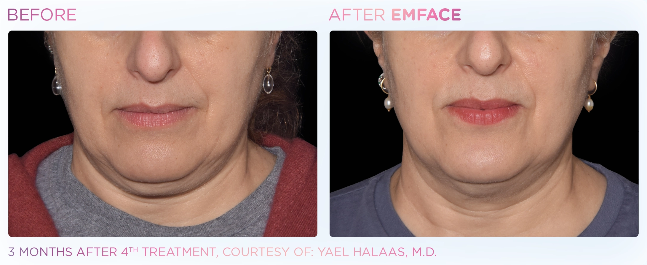 EMFACE Before & After | Image Gallery | Neo Body Med Spa