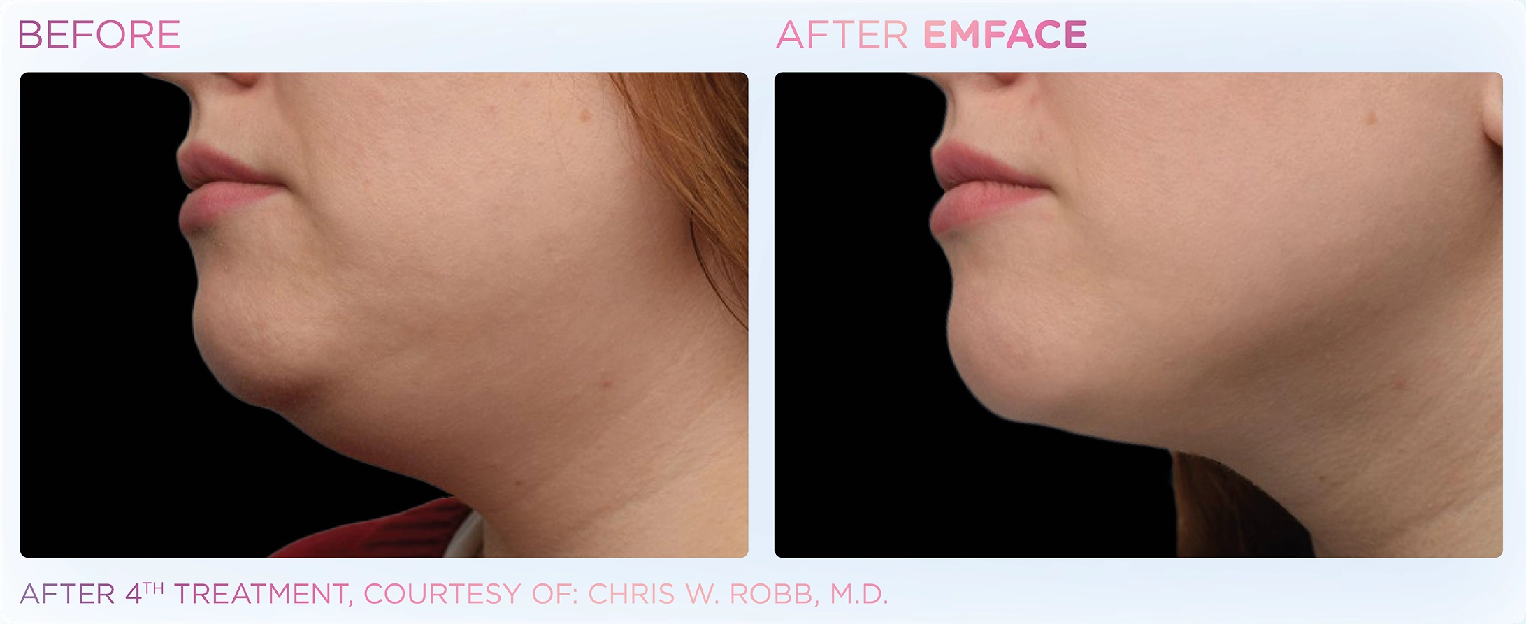 EMFACE Before & After | Image Gallery | Neo Body Med Spa