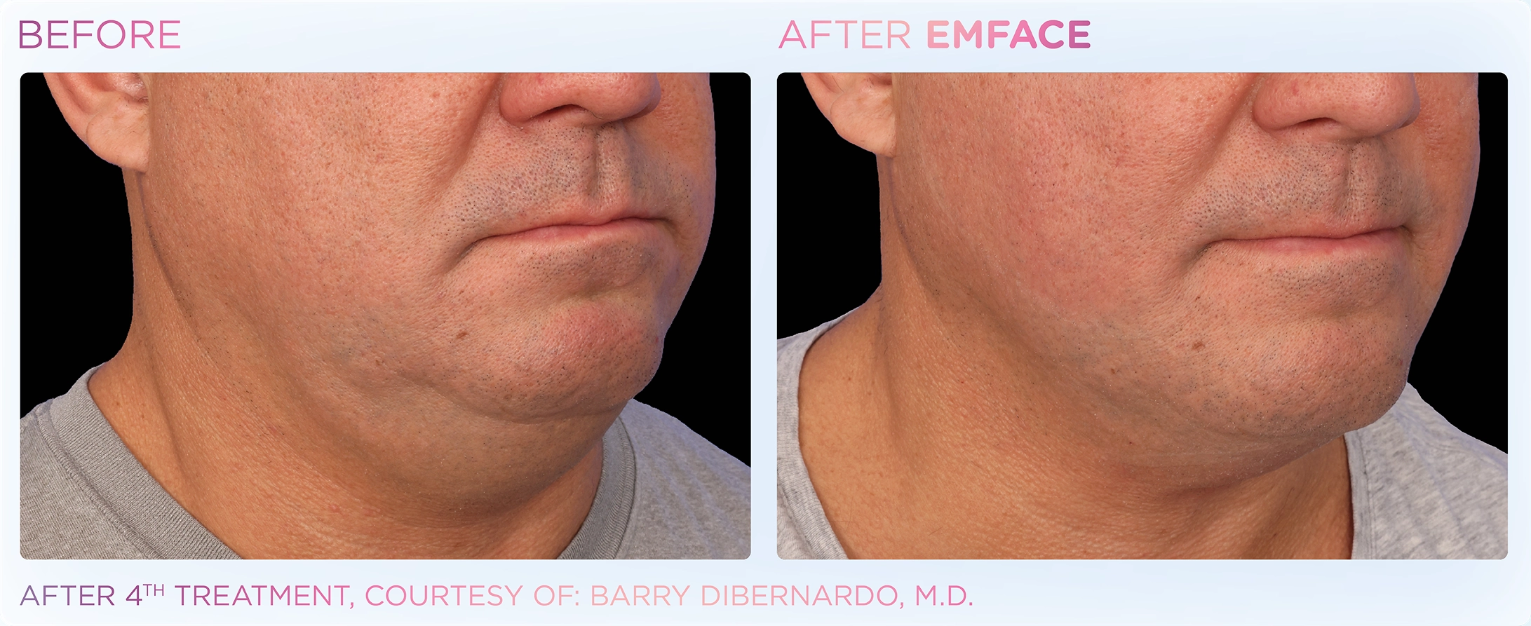 EMFACE Before & After | Image Gallery | Neo Body Med Spa