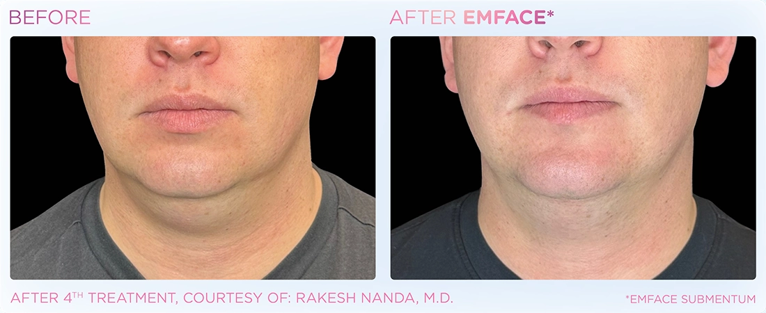 EMFACE Before & After | Image Gallery | Neo Body Med Spa