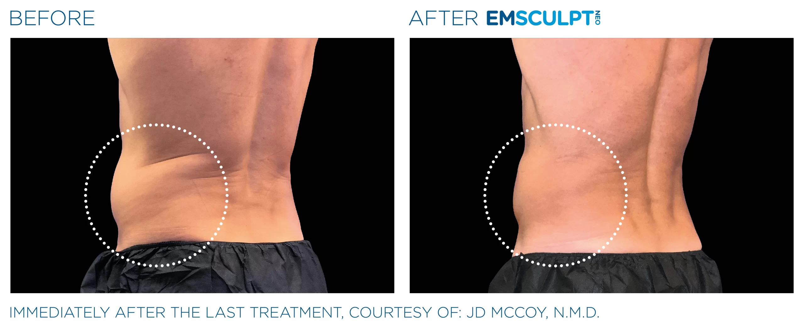 EMSCULPT NEO Before & After | Image Gallery | Neo Body Med Spa