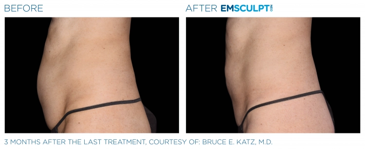 EMSCULPT NEO Before & After | Image Gallery | Neo Body Med Spa