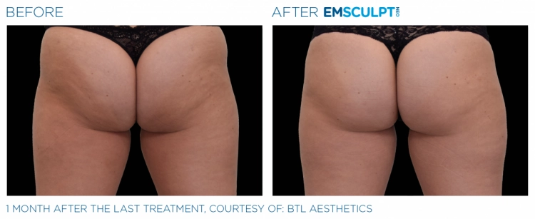 EMSCULPT NEO Before & After | Image Gallery | Neo Body Med Spa