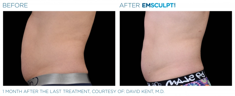 EMSCULPT NEO Before & After | Image Gallery | Neo Body Med Spa