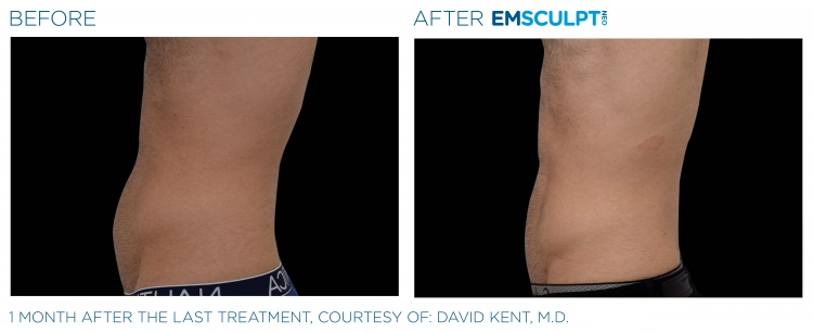 EMSCULPT NEO Before & After | Image Gallery | Neo Body Med Spa