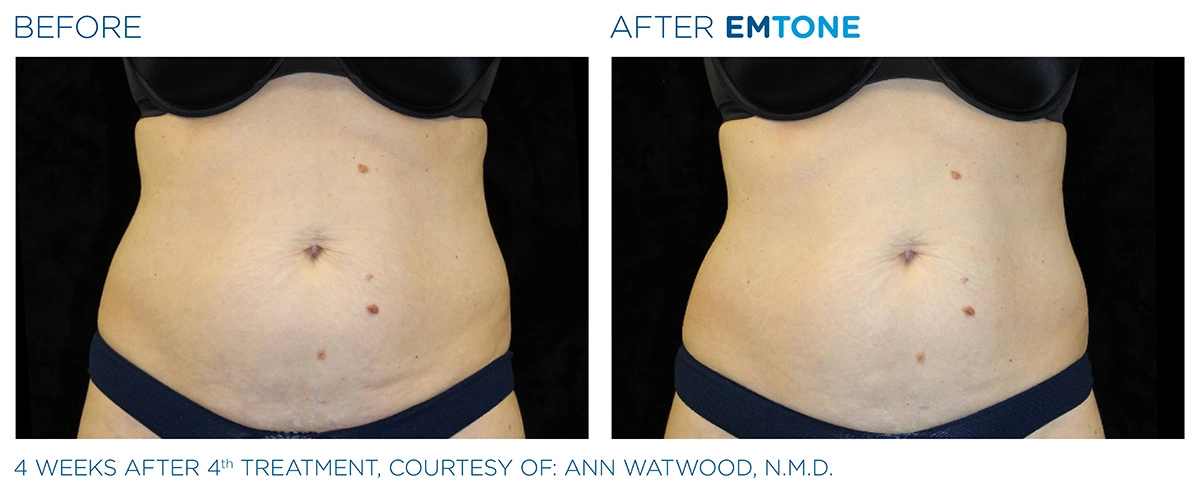 EMTONE Before & After | Image Gallery | Neo Body Med Spa