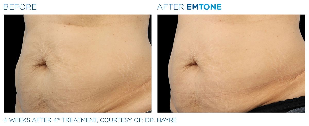 EMTONE Before & After | Image Gallery | Neo Body Med Spa