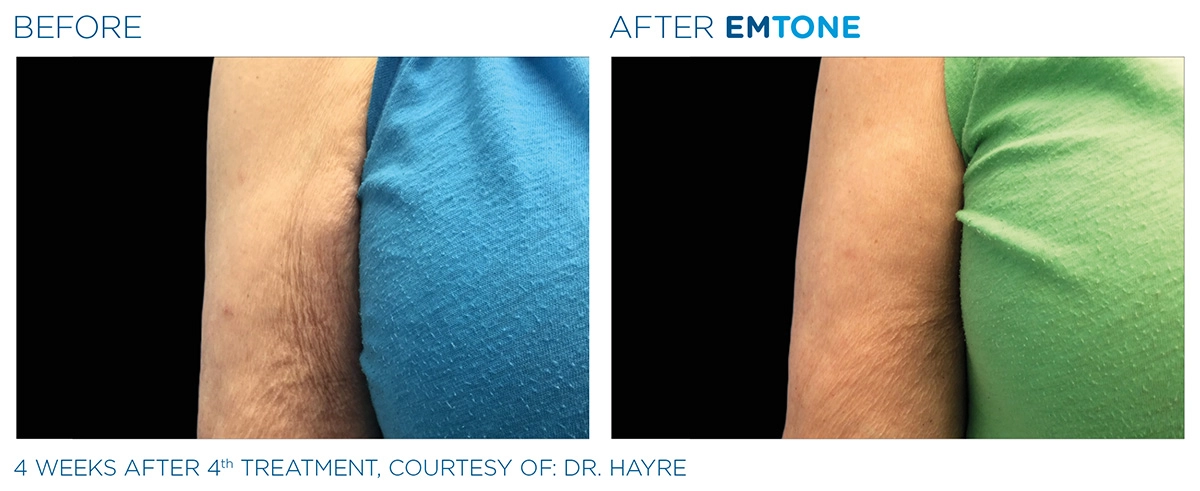 EMTONE Before & After | Image Gallery | Neo Body Med Spa