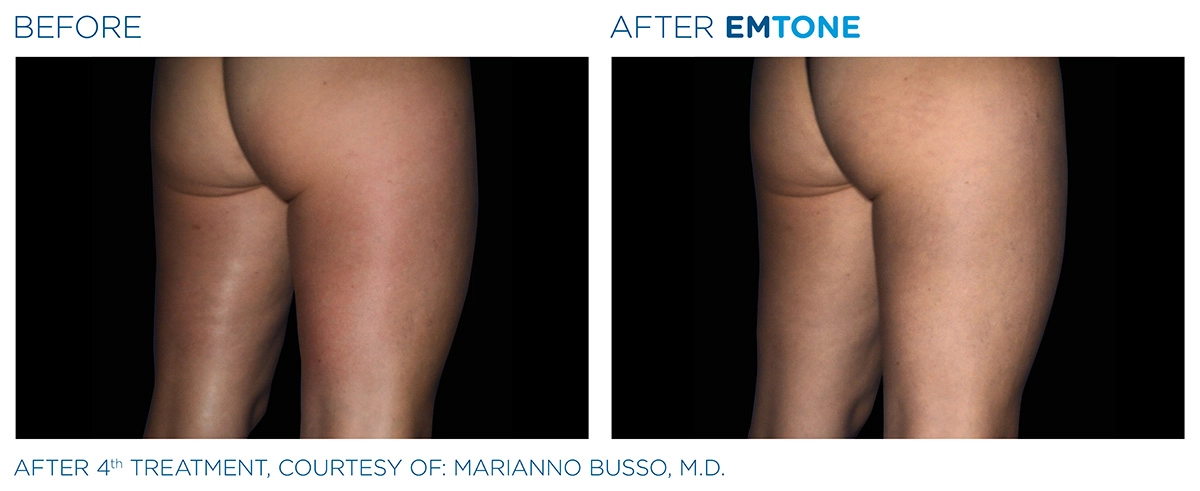 EMTONE Before & After | Image Gallery | Neo Body Med Spa