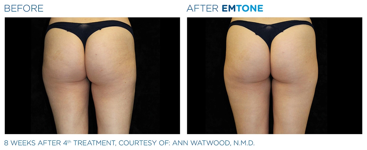 EMTONE Before & After | Image Gallery | Neo Body Med Spa