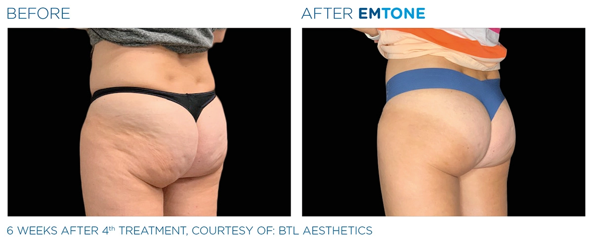 EMTONE Before & After | Image Gallery | Neo Body Med Spa