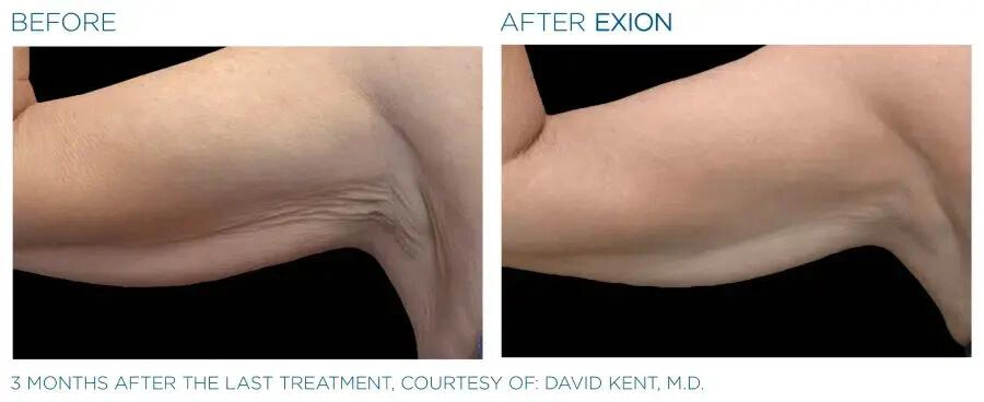 EXION Body Before & After | Skin Rejuvenation | Neo Body Med Spa