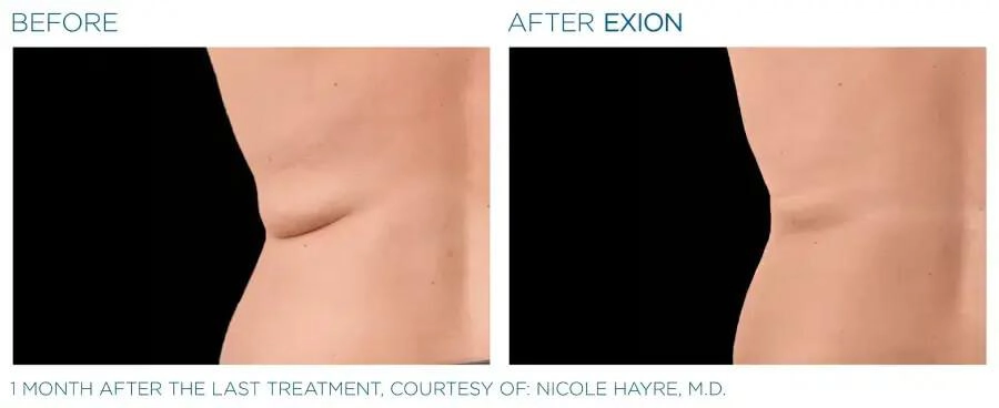 EXION Body Before & After | Skin Rejuvenation | Neo Body Med Spa