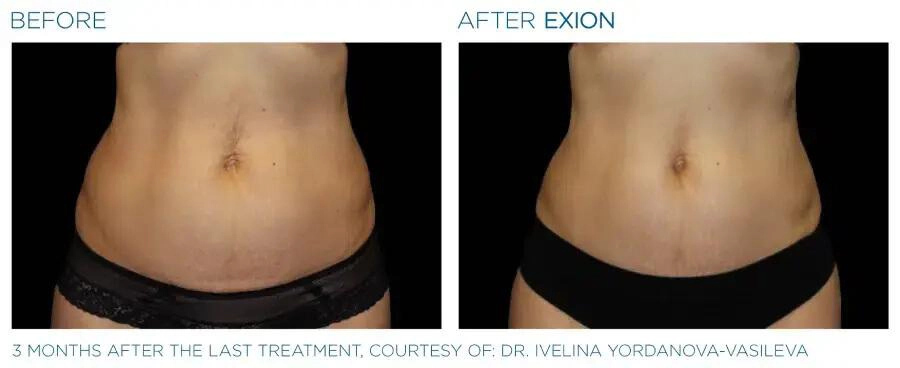 EXION Body Before & After | Skin Rejuvenation | Neo Body Med Spa