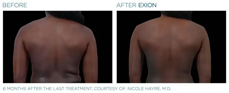 EXION Body Before & After | Skin Rejuvenation | Neo Body Med Spa