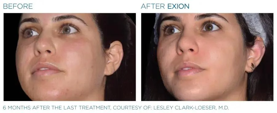 EXION Face Before & After | Image Gallery | Neo Body Med Spa