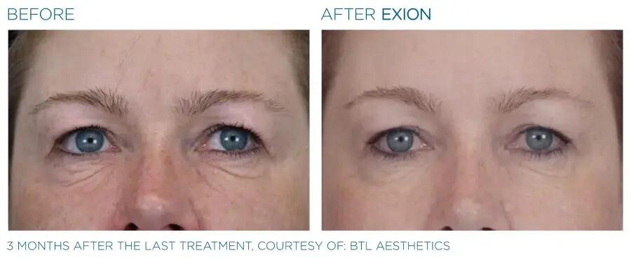 EXION Face Before & After | Image Gallery | Neo Body Med Spa