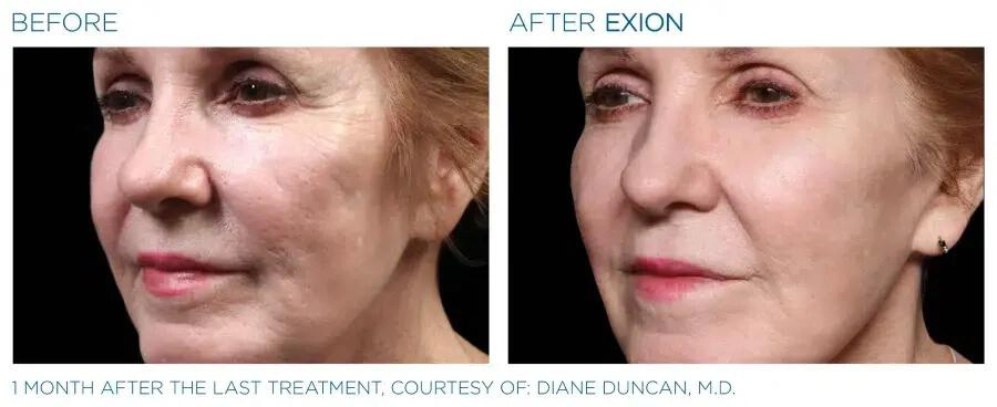EXION Face Before & After | Image Gallery | Neo Body Med Spa