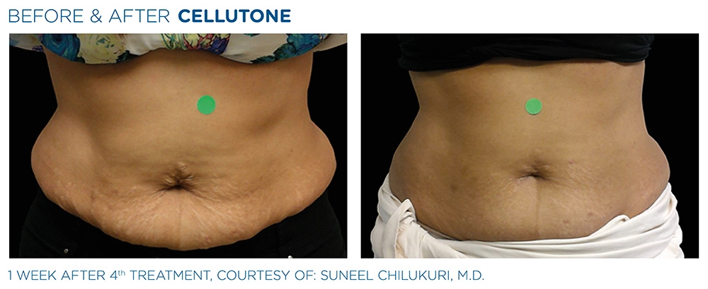 Cellutone Before & After | Image Gallery | Neo Body Med Spa
